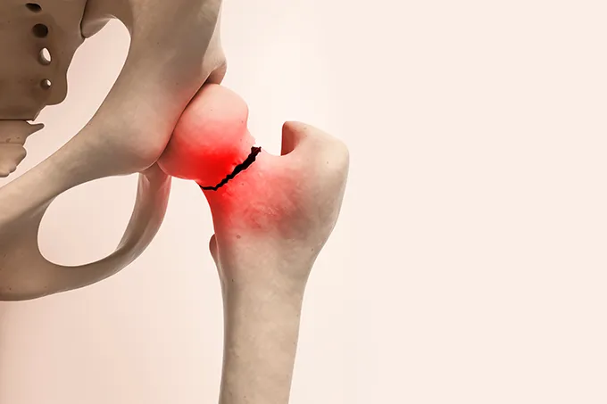 Osteoporose silenciosa exige diagnóstico e prevenção antes da primeira fratura