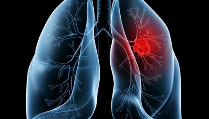 Adenocarcinoma pulmonar: entenda a condição diagnosticada no Papa Leão