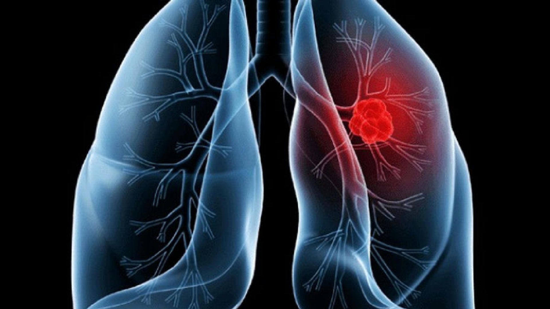 Adenocarcinoma pulmonar: entenda a condição diagnosticada no Papa Leão