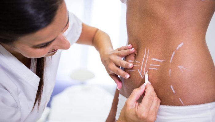 Close-up of surgeon drawing lines on womans abdomen for liposuction and cellulite removal
