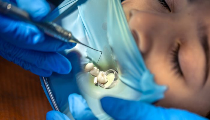 The dentist treats the child's tooth using a rubber dam. Installing a filling in a tooth. High quality photo. Visiting dentist office. Dentistry concept. Installing a rubber dam on the tooth. SSUCv3H4sIAAAAAAAAA41P0W6DMAz8Fz+DBCVslF+p+hBij1oFUiVm1YTy73Mo1V6XpztffHfegBF6IHs6ty1WJQ4VlnVNX+VwrmzpPo2hrunch0MoAK0Q9HXTdKfWVKoZ01b6ChhsZAf9BjxNa5Rghf0CvSqBFqSwQ0IWH9hOylIBUayskaKuKXPqPaq687ffZctzLajhcR0ySMU/Z9cC7EiL+8n+KReZyO5xF5XuT6EwH9lebrliho/Ajpfx6KSn+PmFFy95d08Q7+6Mx/LrjBvrNOQsWB+Tt0h4yOsws8ibBvpmev79Tin9AvnqAdSEAQAA