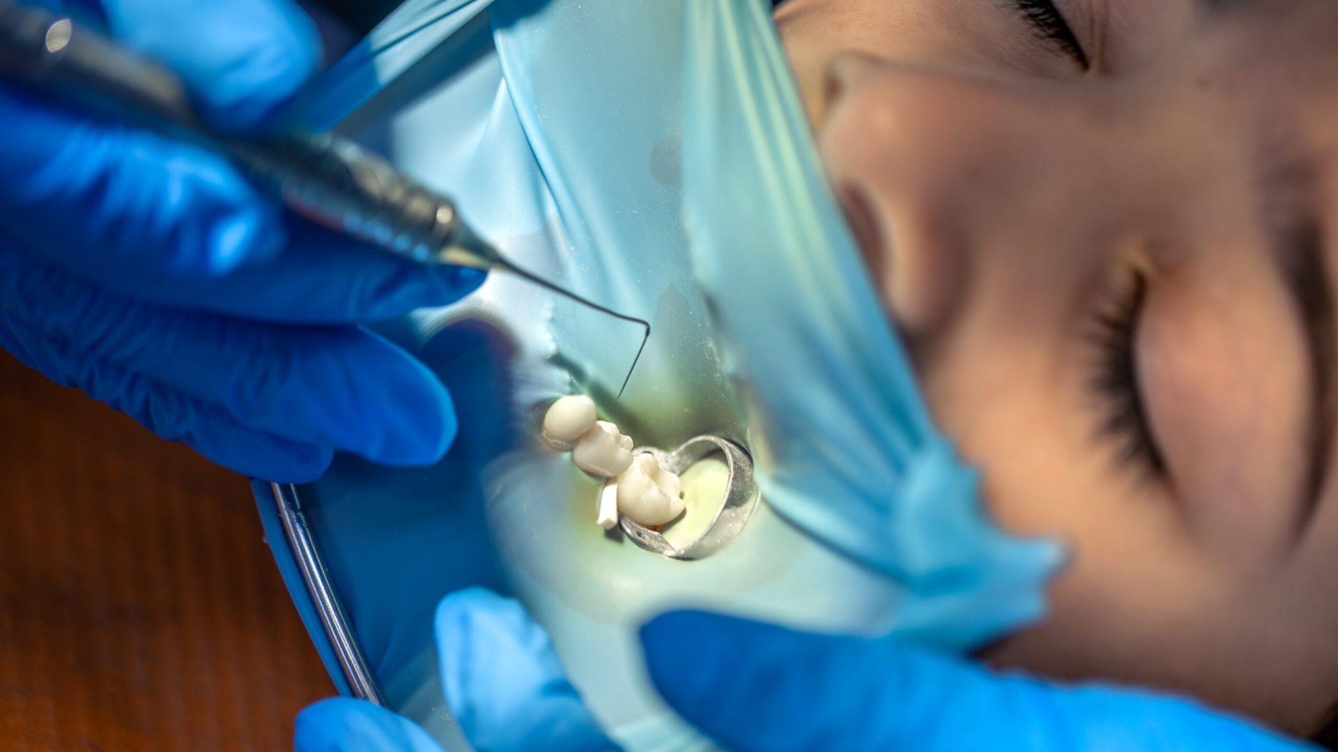 The dentist treats the child's tooth using a rubber dam. Installing a filling in a tooth. High quality photo. Visiting dentist office. Dentistry concept. Installing a rubber dam on the tooth. SSUCv3H4sIAAAAAAAAA41P0W6DMAz8Fz+DBCVslF+p+hBij1oFUiVm1YTy73Mo1V6XpztffHfegBF6IHs6ty1WJQ4VlnVNX+VwrmzpPo2hrunch0MoAK0Q9HXTdKfWVKoZ01b6ChhsZAf9BjxNa5Rghf0CvSqBFqSwQ0IWH9hOylIBUayskaKuKXPqPaq687ffZctzLajhcR0ySMU/Z9cC7EiL+8n+KReZyO5xF5XuT6EwH9lebrliho/Ajpfx6KSn+PmFFy95d08Q7+6Mx/LrjBvrNOQsWB+Tt0h4yOsws8ibBvpmev79Tin9AvnqAdSEAQAA