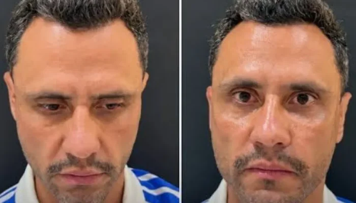 Harmonização facial de Cleitinho Azevedo ocorre logo após vitória nas urnas em Minas Gerais