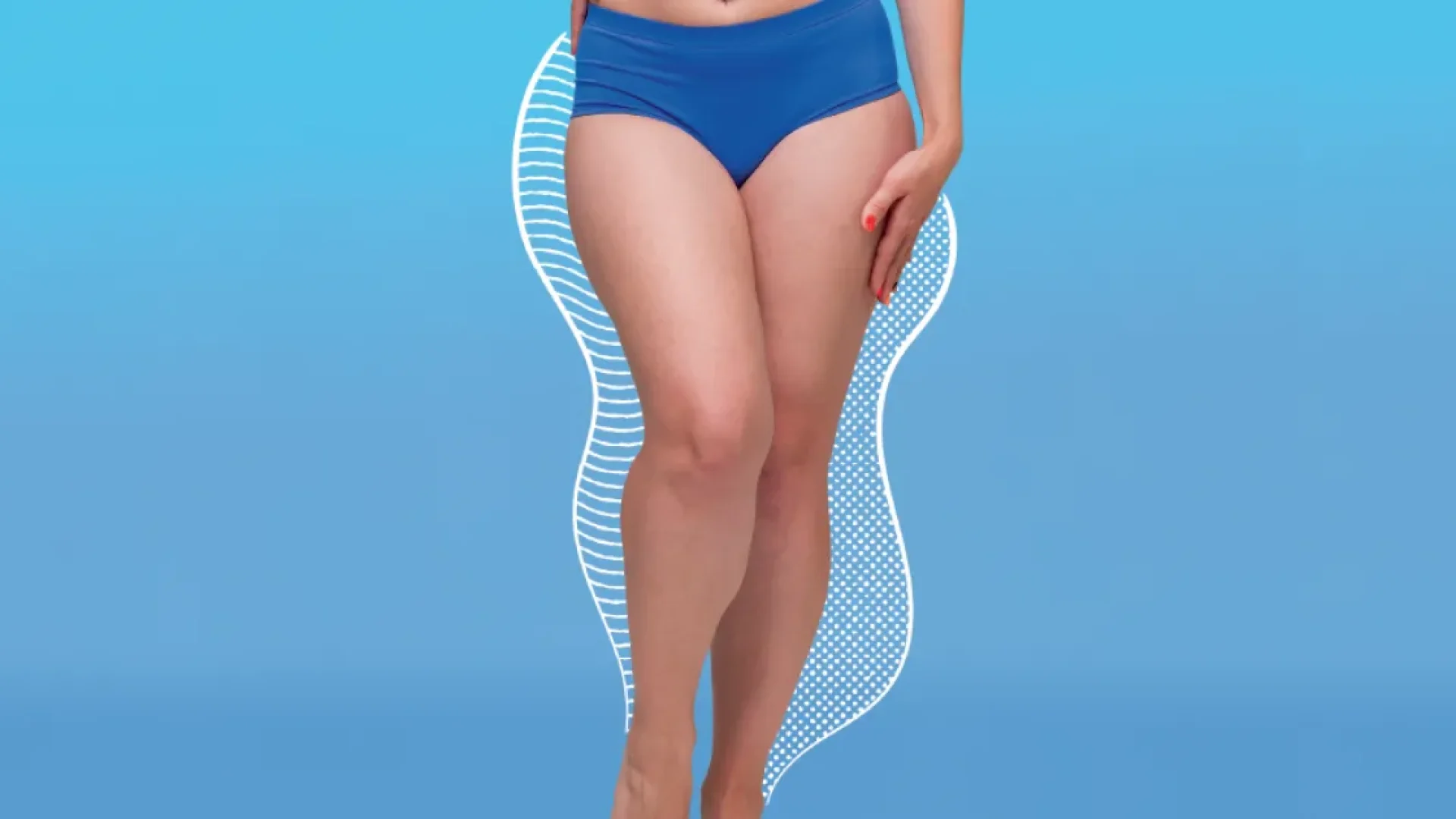 Lipedema ou celulite: como diferenciar condições estéticas de problemas médicos