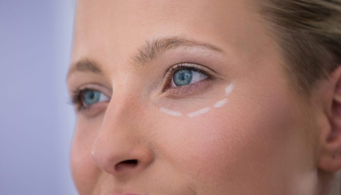 Close-up of woman with marks drawn for cosmetic treatment