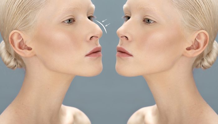 mulher-se-preparando-para-cirurgia-de-nariz-2