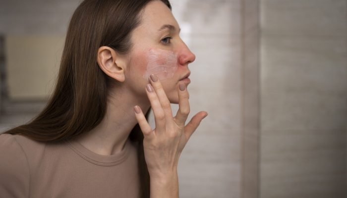 mulher-usando-hidratante-para-ajudar-com-rosacea