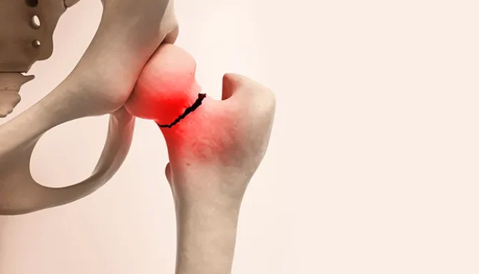 Osteoporose silenciosa exige diagnóstico e prevenção antes da primeira fratura