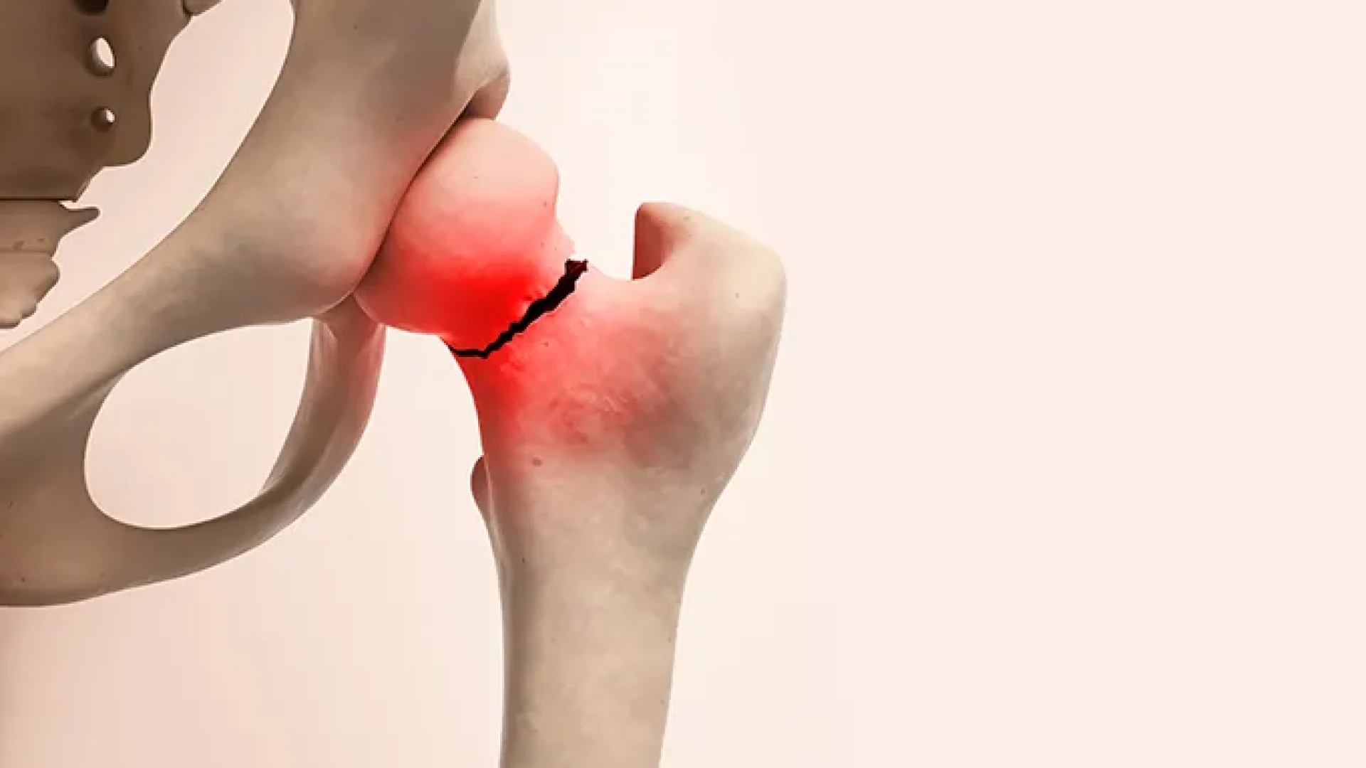 Osteoporose silenciosa exige diagnóstico e prevenção antes da primeira fratura