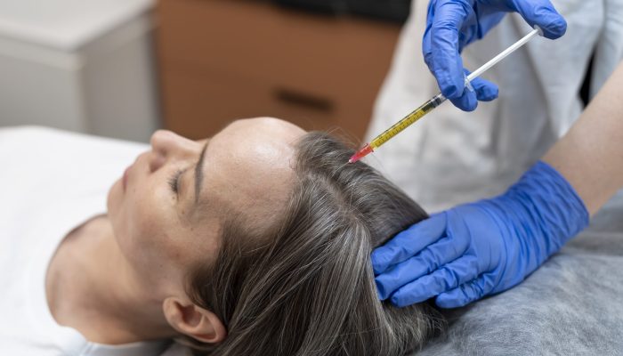 paciente-de-alto-angulo-recebendo-injecao-de-prp-para-alopecia