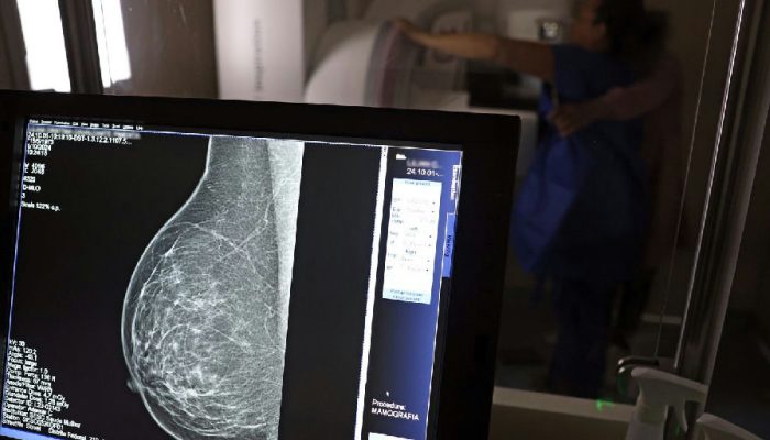 Planos de saúde passam a cobrir mamografia digital sem restrição de idade