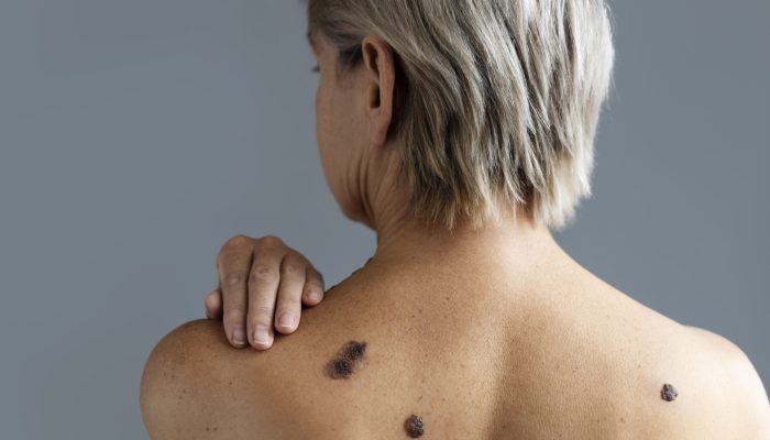 vista-traseira-mulher-com-cancer-de-pele